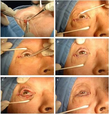 Outcomes of Lateral Tarsal Strip in Conjunction with a Minimal Skin Muscle Excision Underlying Cauterization in Korean Patients with Involutional Entropion